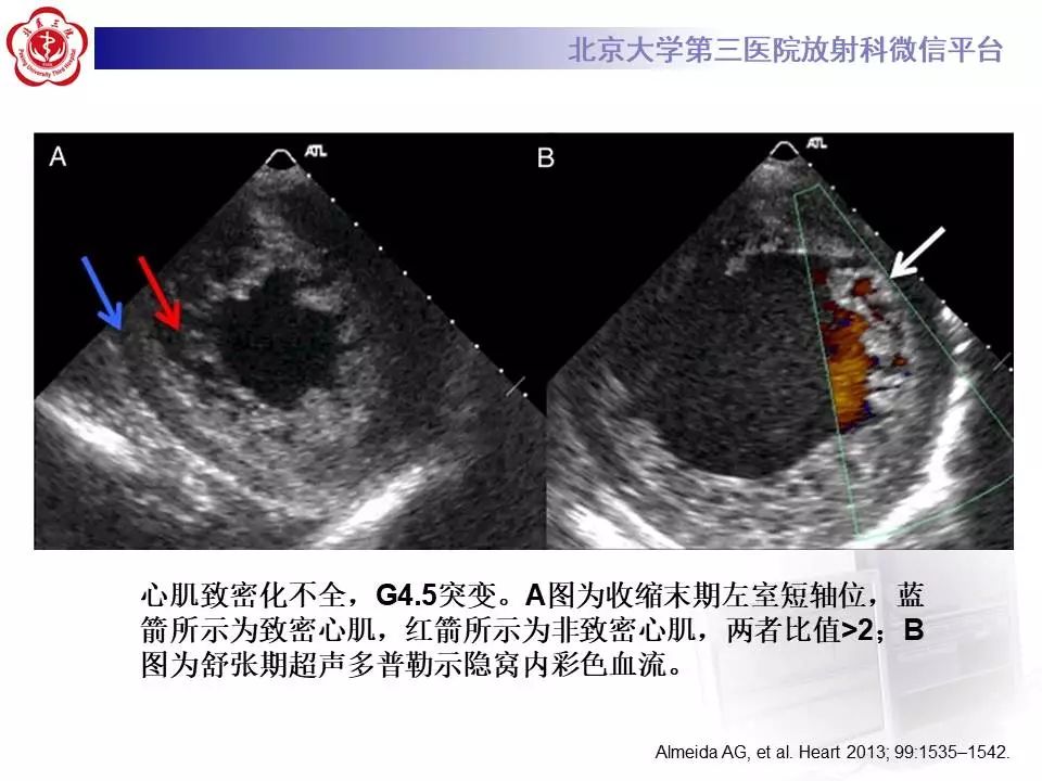 【病例】心肌致密化不全1例MR