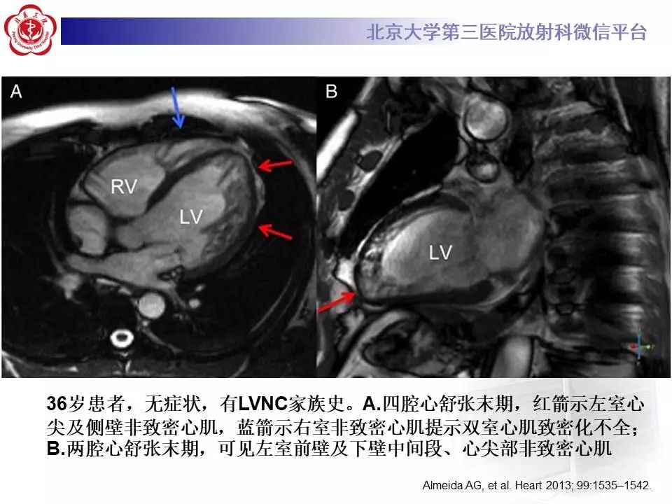 【病例】心肌致密化不全1例MR
