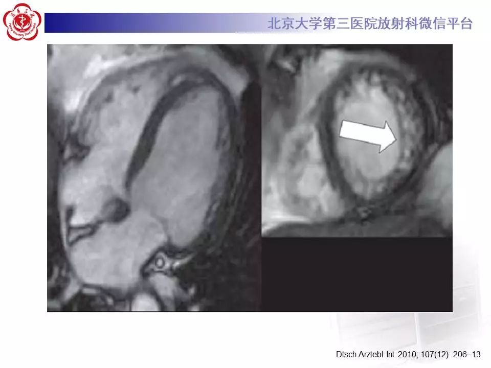 【病例】心肌致密化不全1例MR