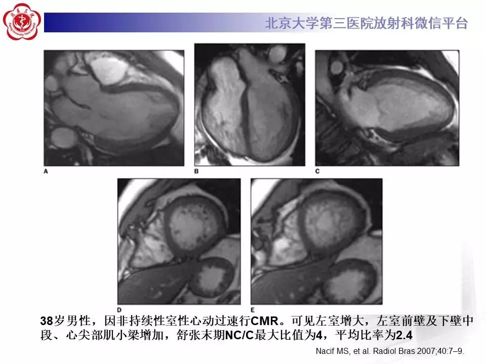 【病例】心肌致密化不全1例MR