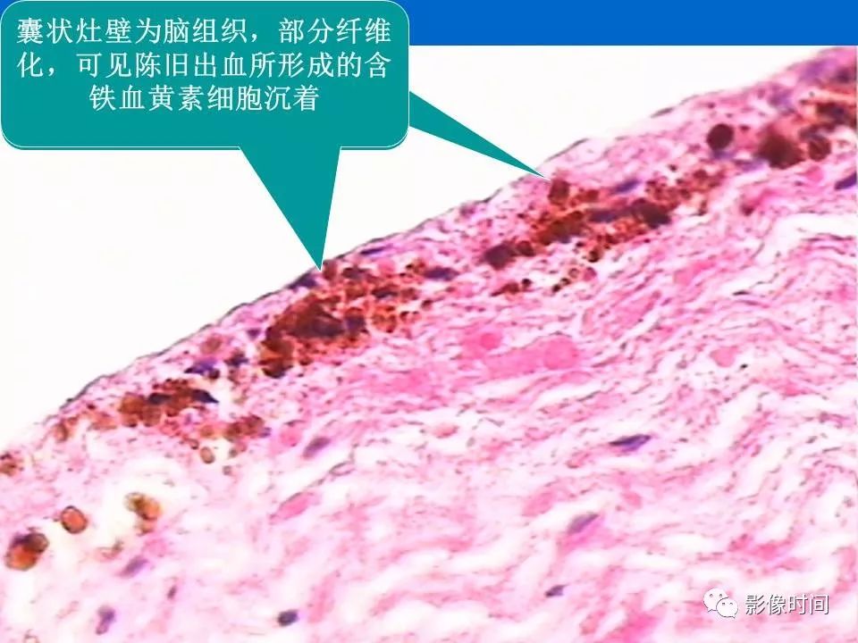 【PPT】Fahr病临床影像诊断与鉴别诊断