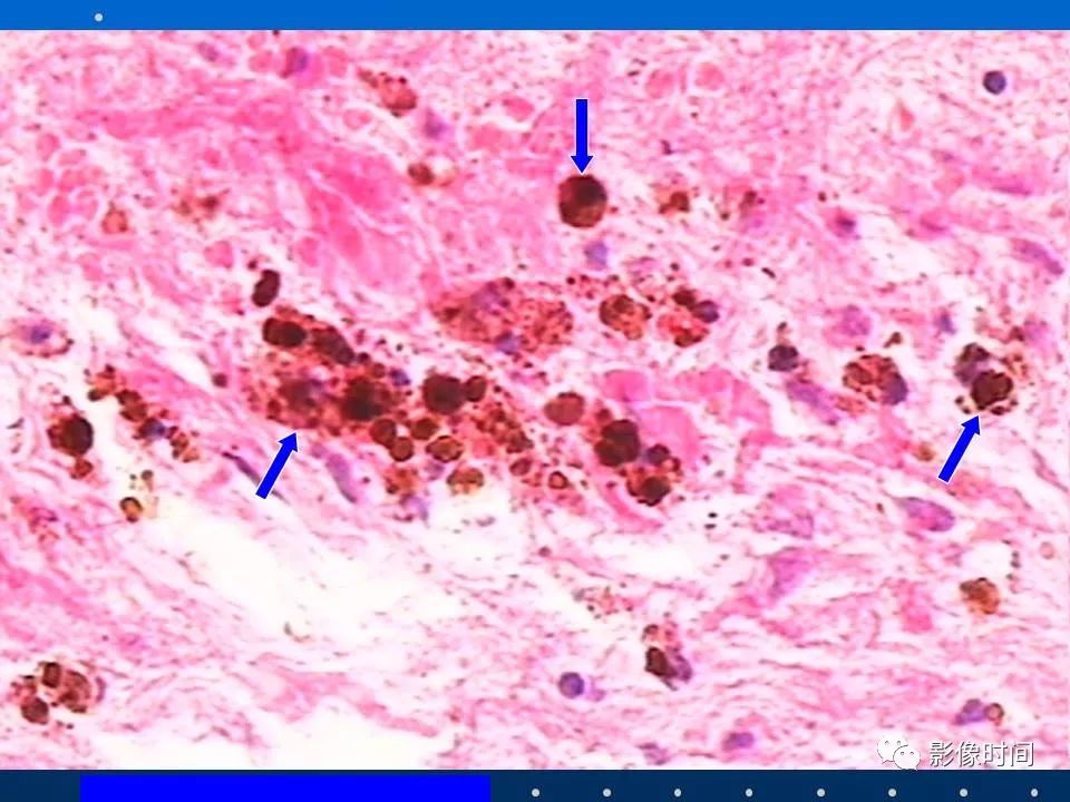 【PPT】Fahr病临床影像诊断与鉴别诊断