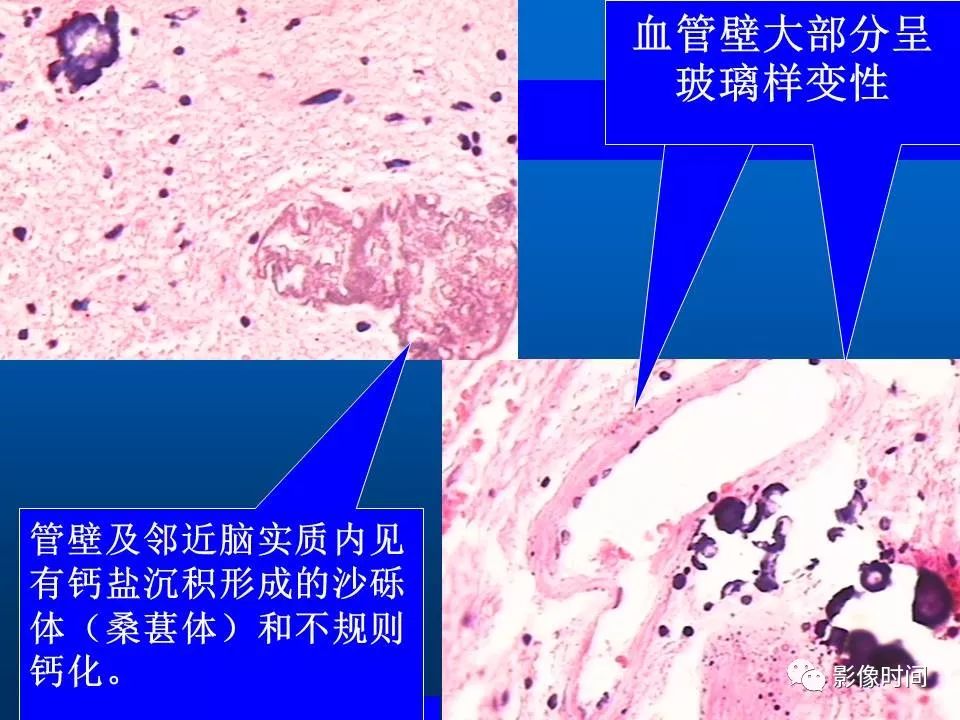 【PPT】Fahr病临床影像诊断与鉴别诊断