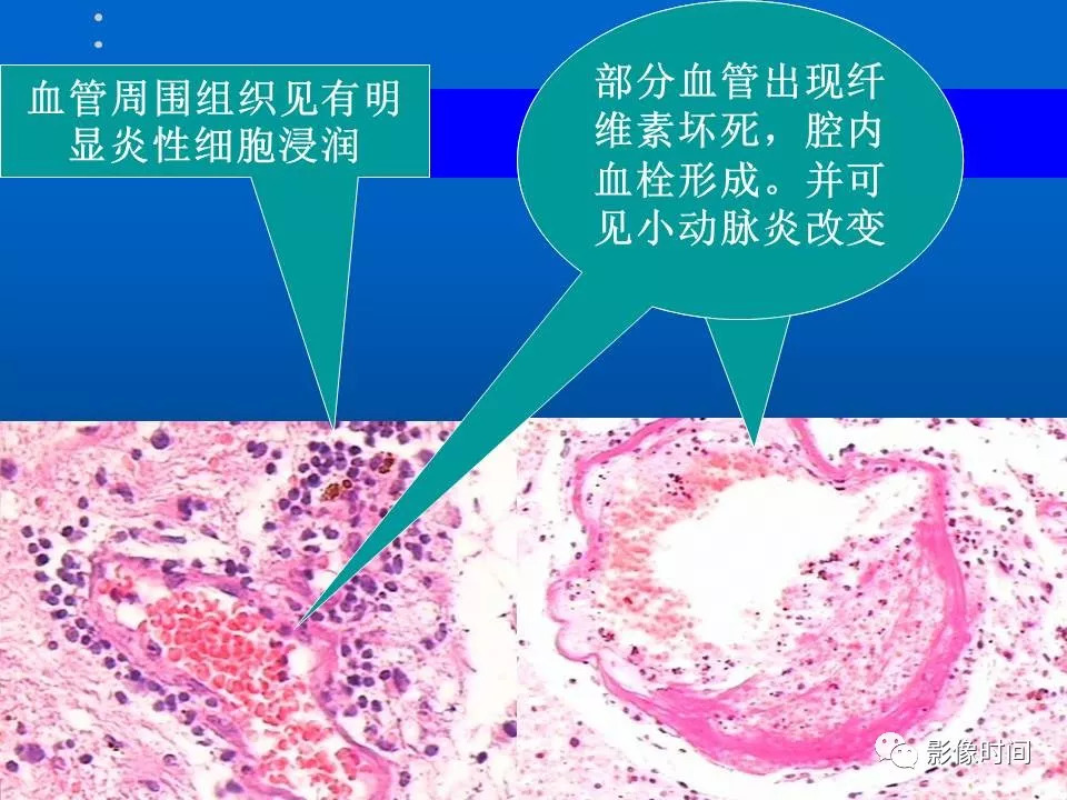 【PPT】Fahr病临床影像诊断与鉴别诊断