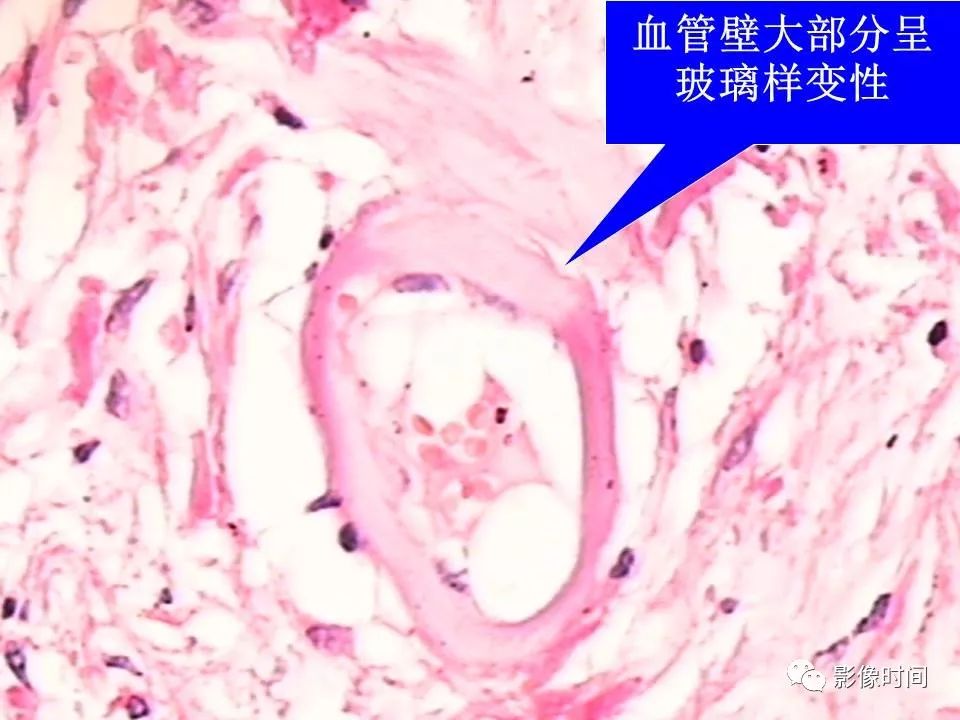 【PPT】Fahr病临床影像诊断与鉴别诊断