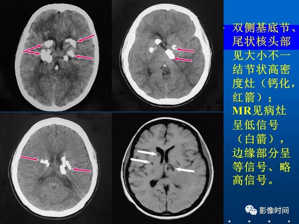 【PPT】Fahr病临床影像诊断与鉴别诊断