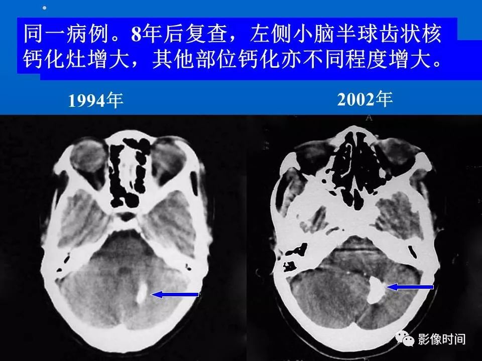 【PPT】Fahr病临床影像诊断与鉴别诊断