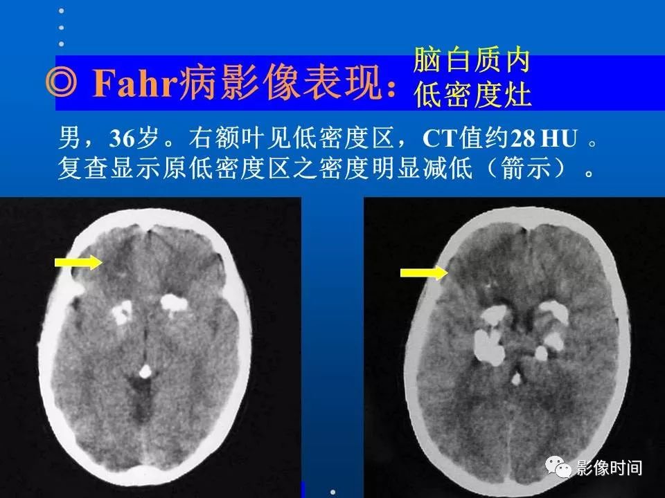 【PPT】Fahr病临床影像诊断与鉴别诊断