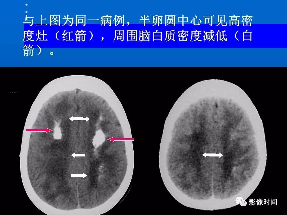 【PPT】Fahr病临床影像诊断与鉴别诊断