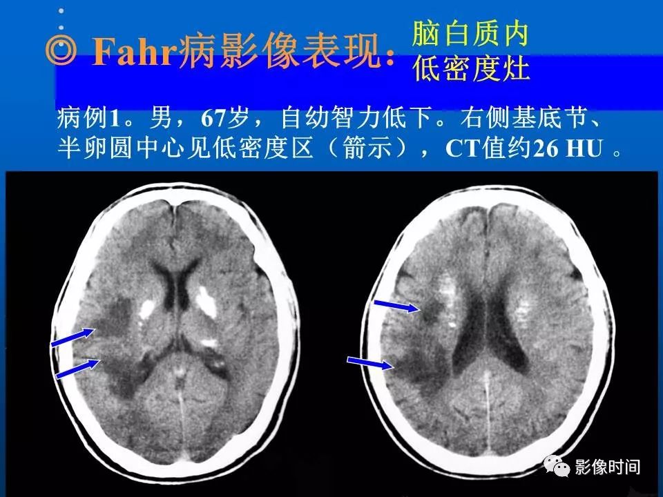 【PPT】Fahr病临床影像诊断与鉴别诊断