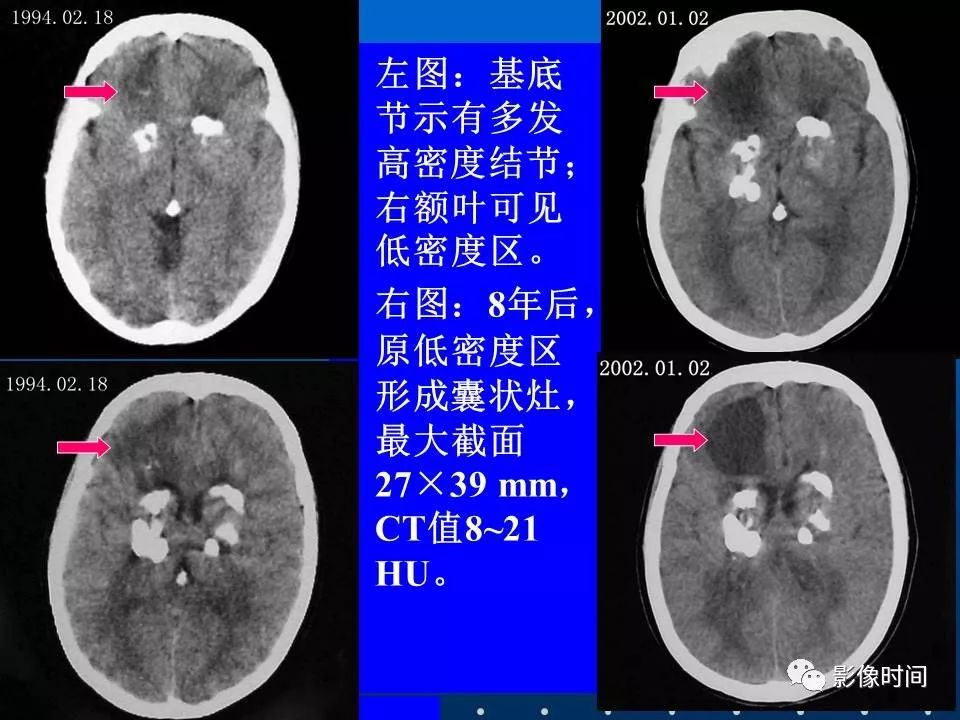 【PPT】Fahr病临床影像诊断与鉴别诊断
