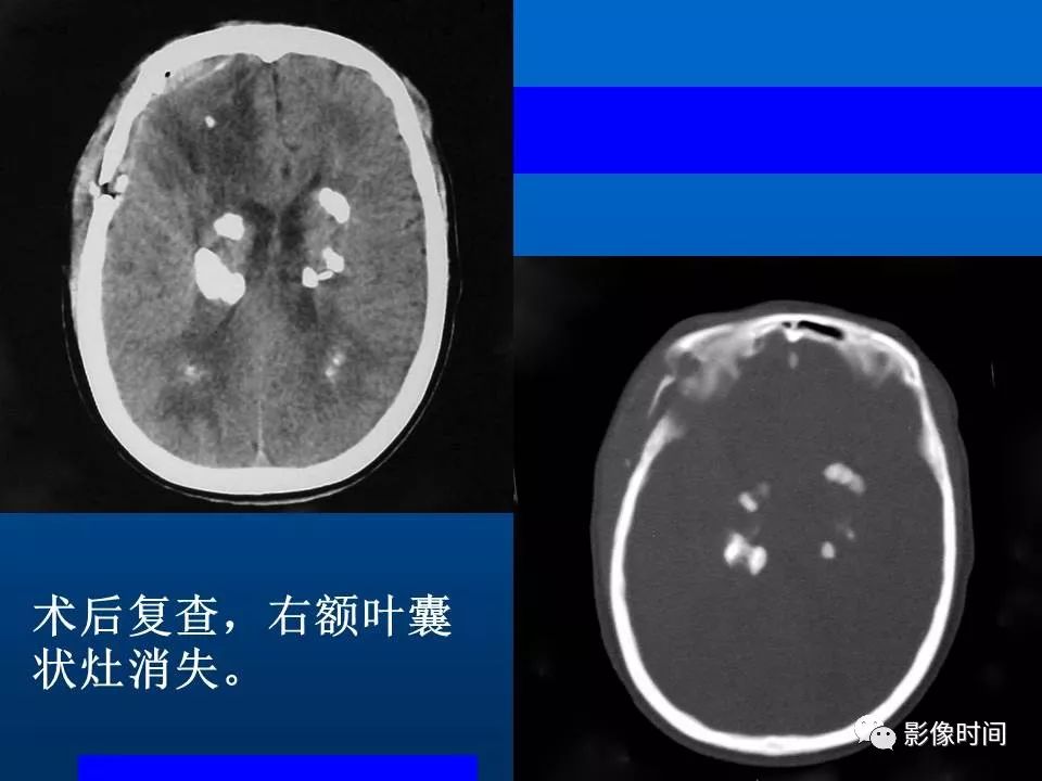 【PPT】Fahr病临床影像诊断与鉴别诊断