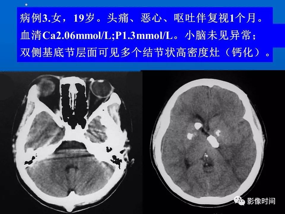 【PPT】Fahr病临床影像诊断与鉴别诊断