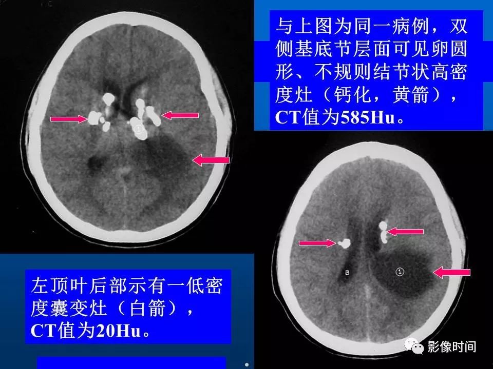 【PPT】Fahr病临床影像诊断与鉴别诊断