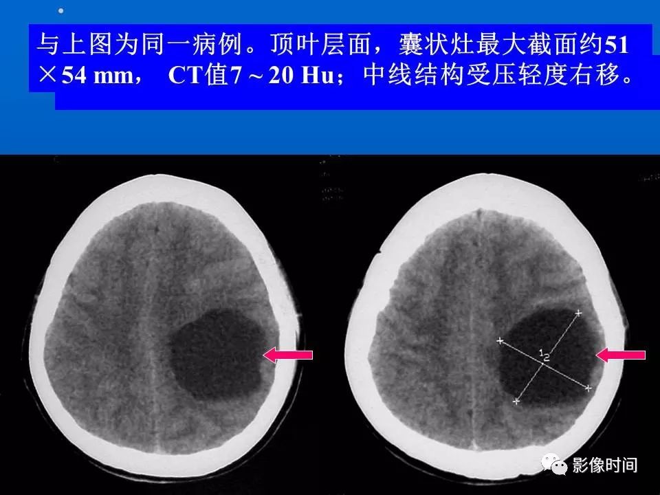 【PPT】Fahr病临床影像诊断与鉴别诊断