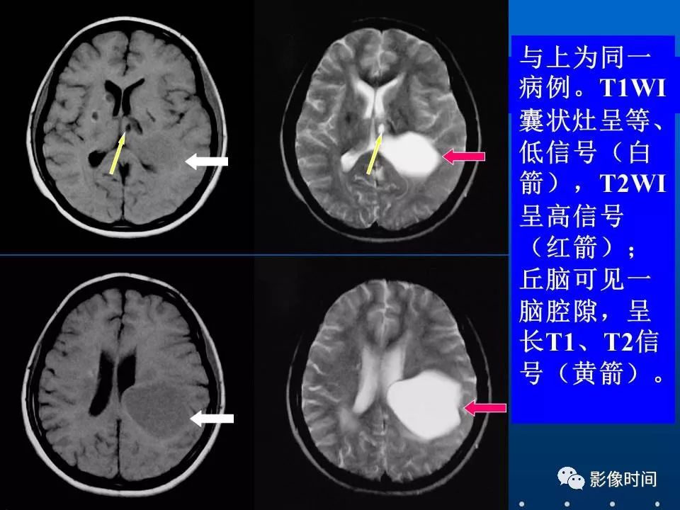 【PPT】Fahr病临床影像诊断与鉴别诊断