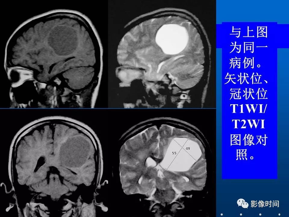 【PPT】Fahr病临床影像诊断与鉴别诊断