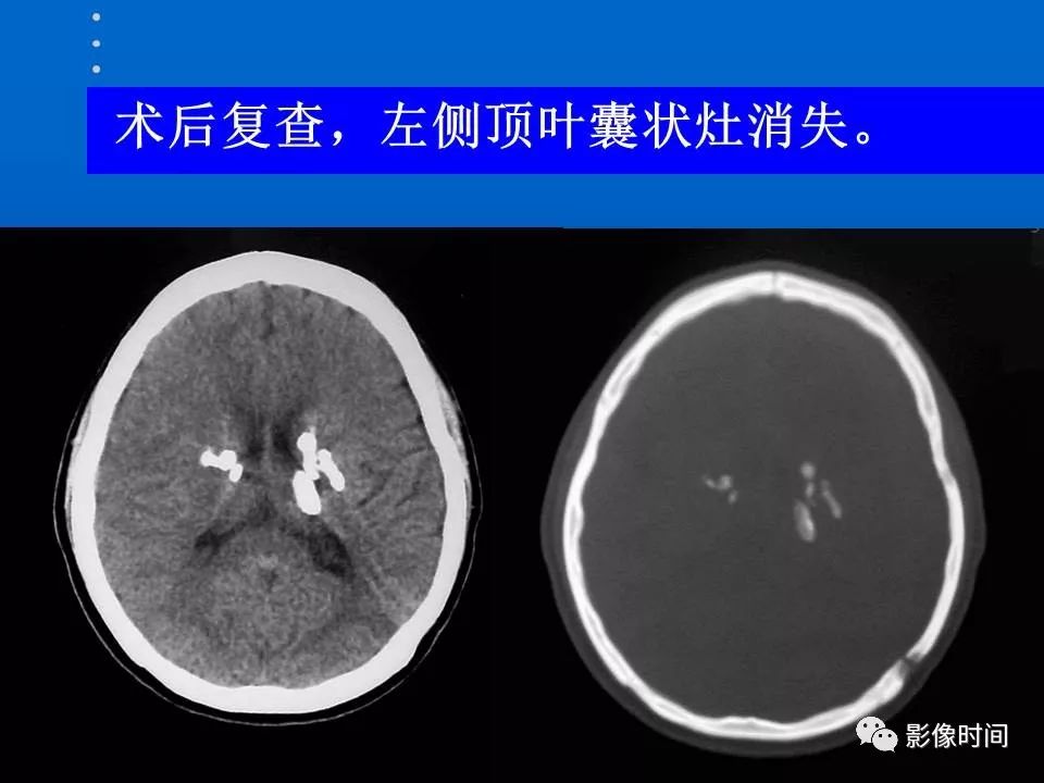 【PPT】Fahr病临床影像诊断与鉴别诊断
