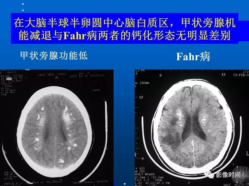 【PPT】Fahr病临床影像诊断与鉴别诊断