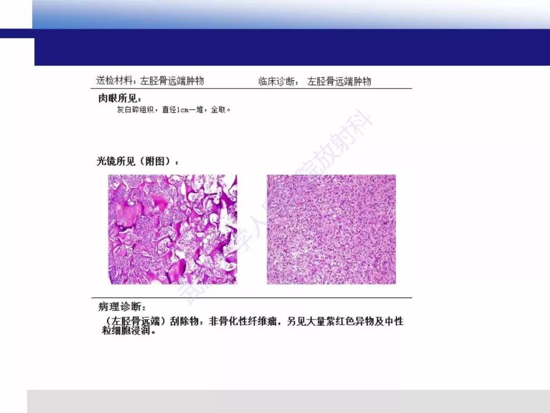 【PPT】非骨化纤维瘤影像诊断