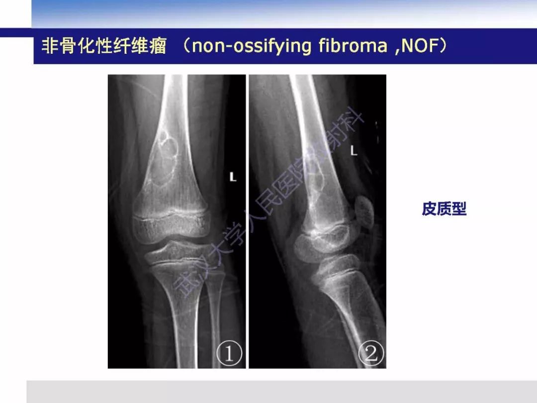 【PPT】非骨化纤维瘤影像诊断