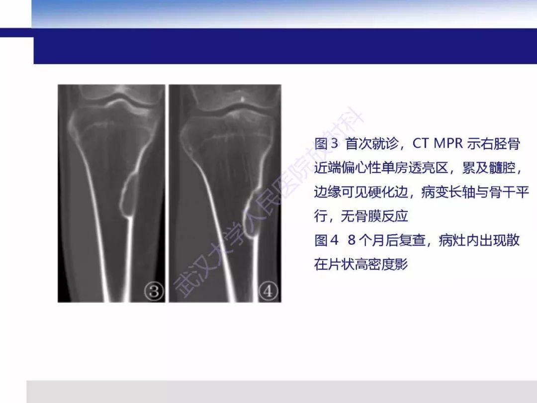 【PPT】非骨化纤维瘤影像诊断