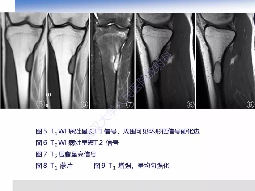 【PPT】非骨化纤维瘤影像诊断