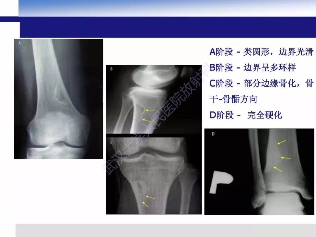 【PPT】非骨化纤维瘤影像诊断