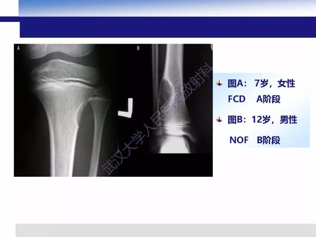 【PPT】非骨化纤维瘤影像诊断