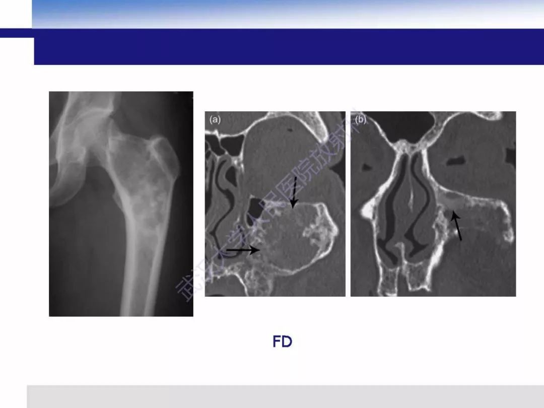【PPT】非骨化纤维瘤影像诊断