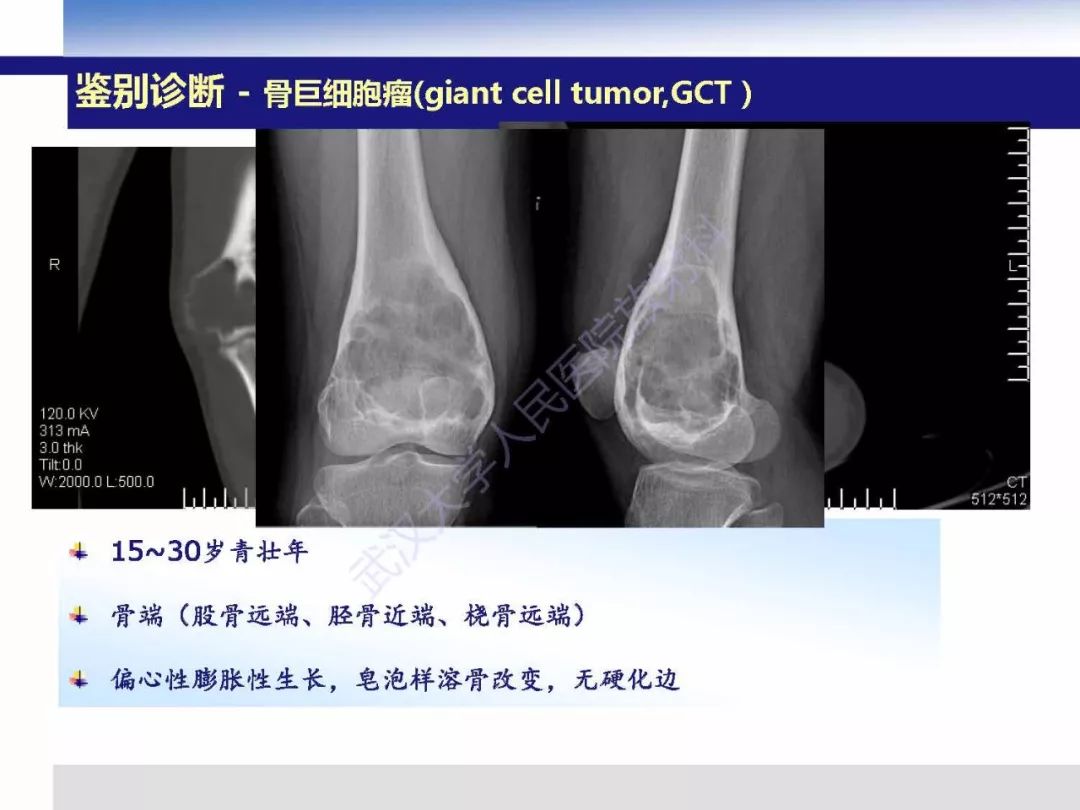 【PPT】非骨化纤维瘤影像诊断