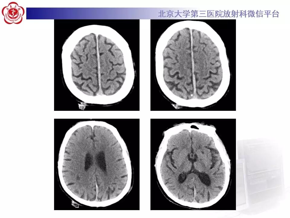 【病例】大脑镰硬膜下血肿1例CT及MR