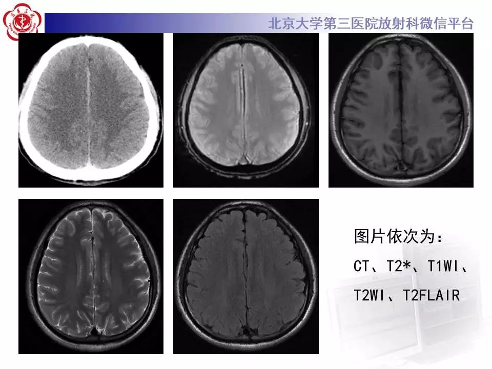 【病例】大脑镰硬膜下血肿1例CT及MR
