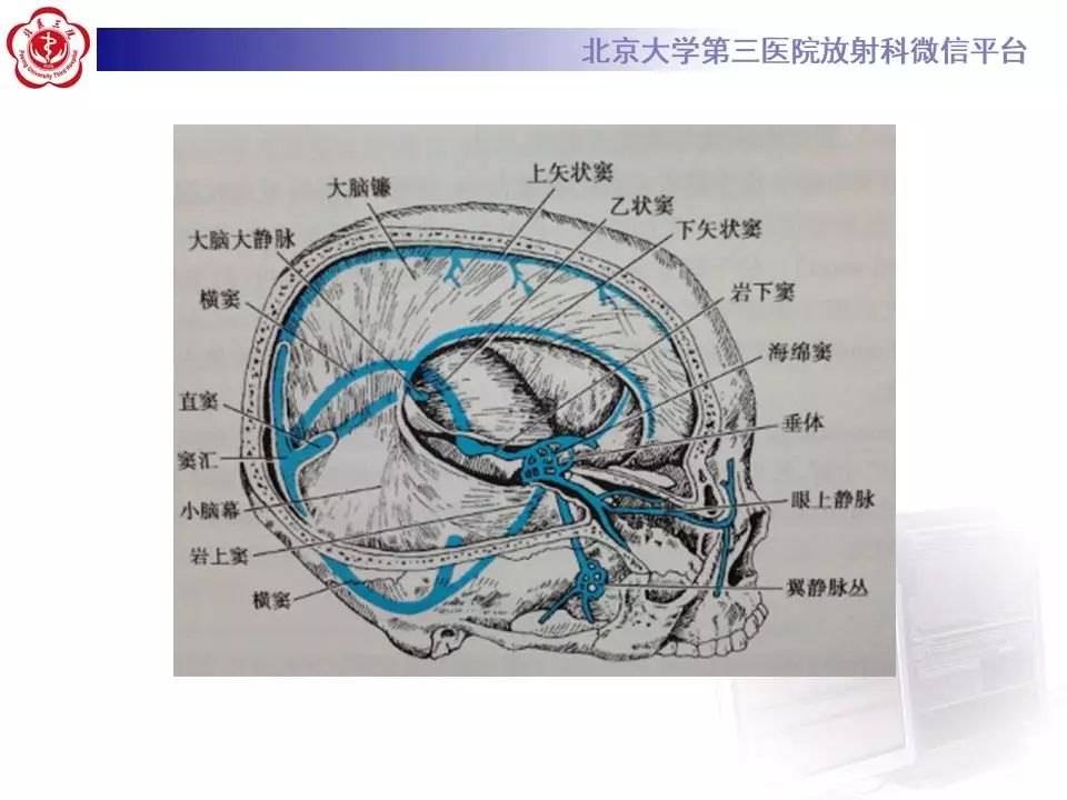 【病例】大脑镰硬膜下血肿1例CT及MR