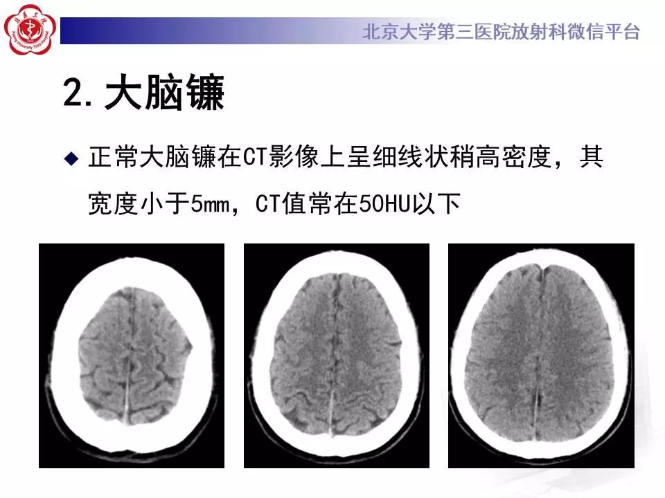 【病例】大脑镰硬膜下血肿1例CT及MR