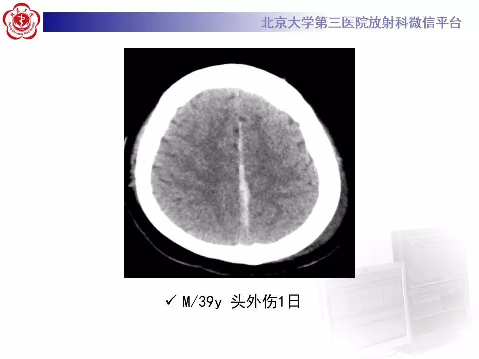 【病例】大脑镰硬膜下血肿1例CT及MR