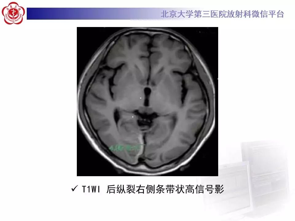 【病例】大脑镰硬膜下血肿1例CT及MR