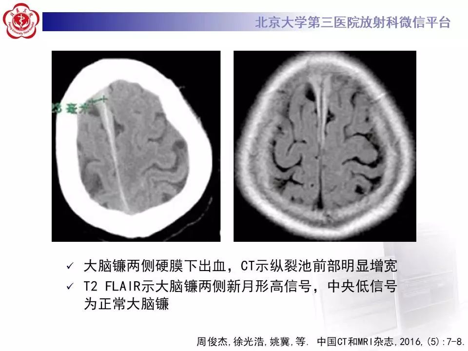 【病例】大脑镰硬膜下血肿1例CT及MR