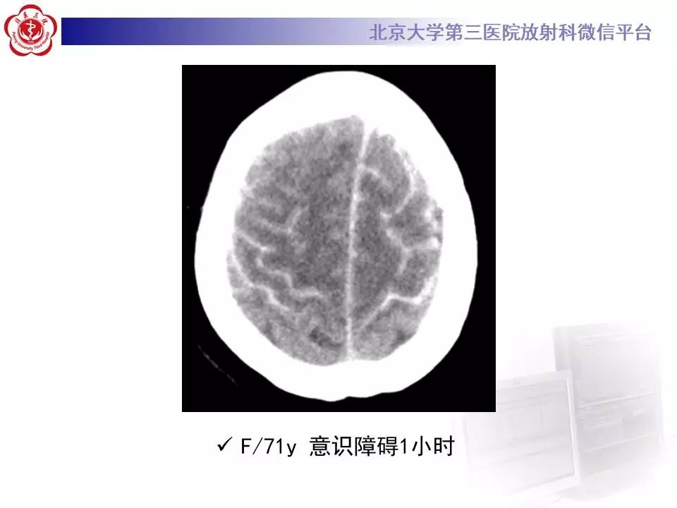 【病例】大脑镰硬膜下血肿1例CT及MR