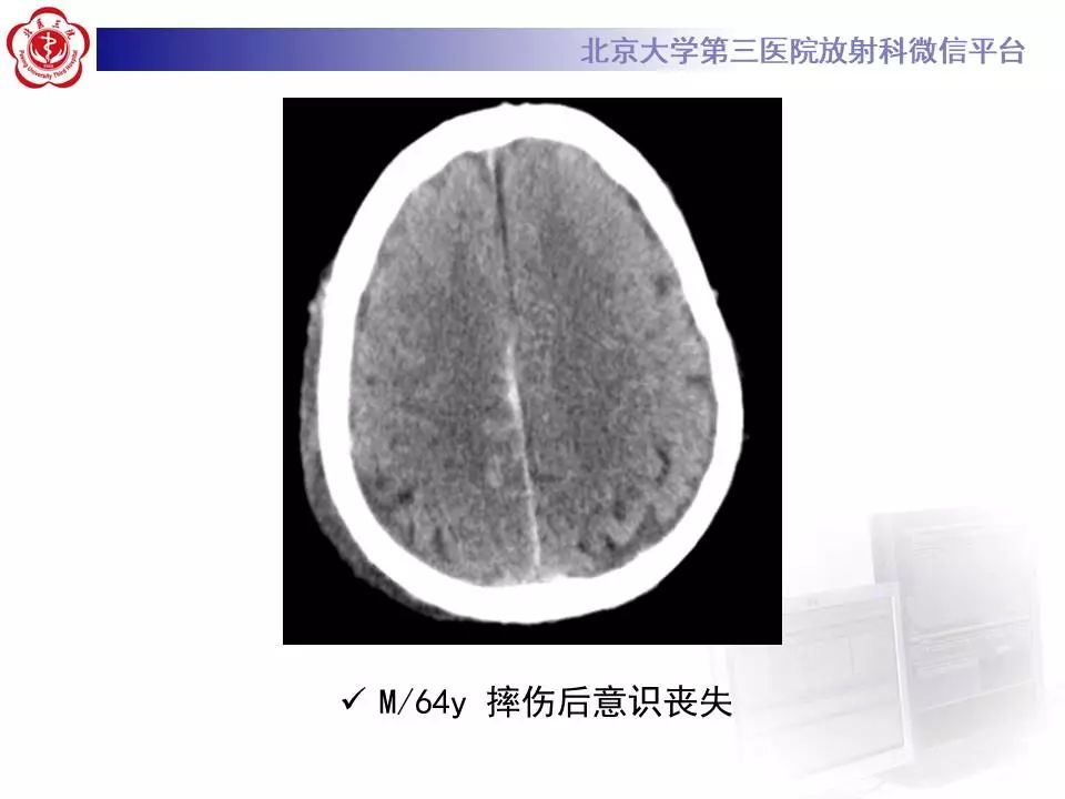 【病例】大脑镰硬膜下血肿1例CT及MR