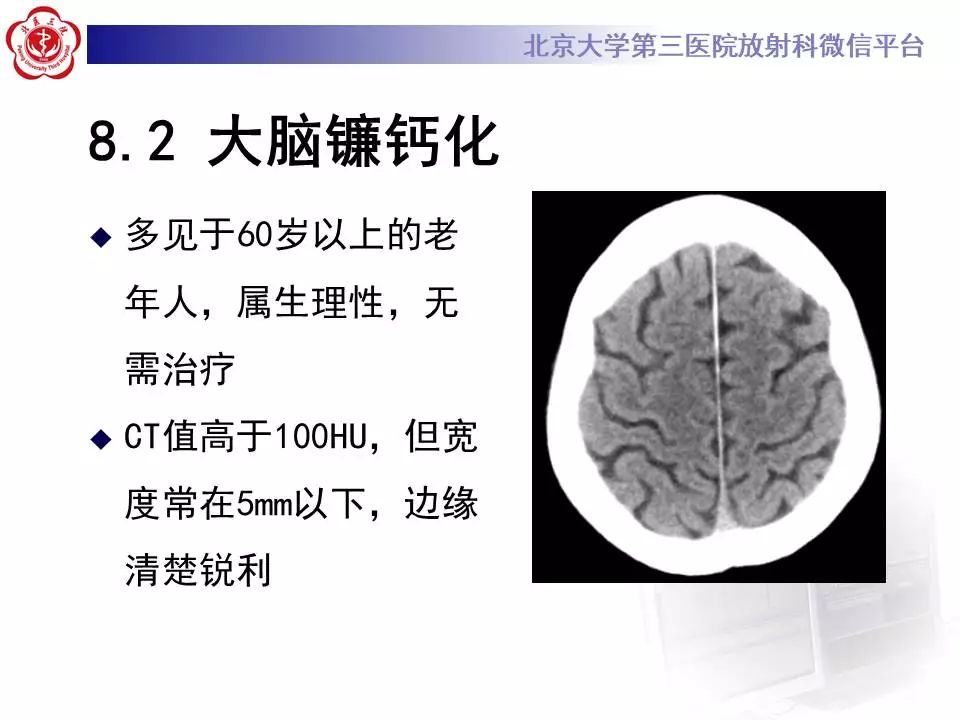 【病例】大脑镰硬膜下血肿1例CT及MR