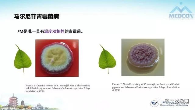 【PPT】AIDS并发播散性真菌病的CT表现