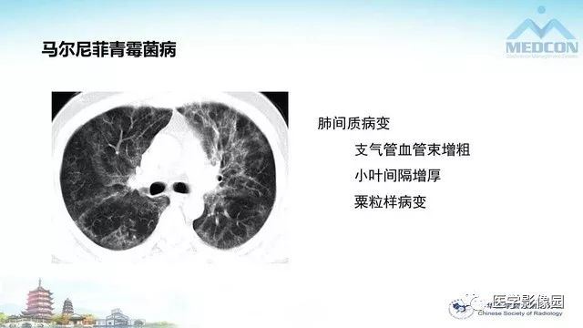 【PPT】AIDS并发播散性真菌病的CT表现