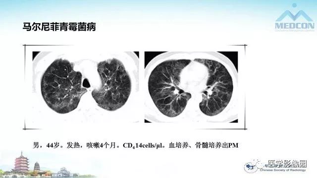 【PPT】AIDS并发播散性真菌病的CT表现