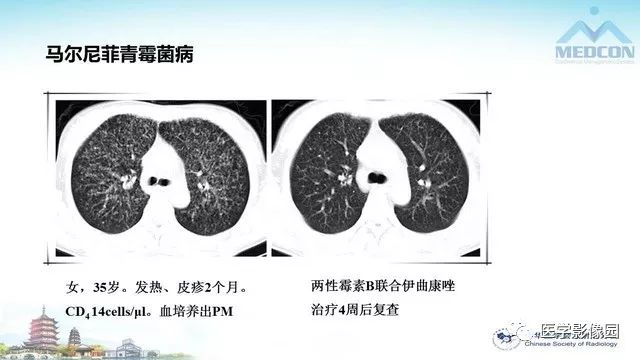 【PPT】AIDS并发播散性真菌病的CT表现