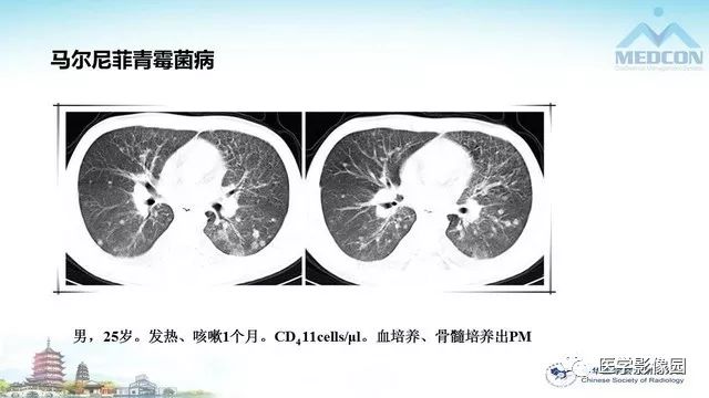 【PPT】AIDS并发播散性真菌病的CT表现