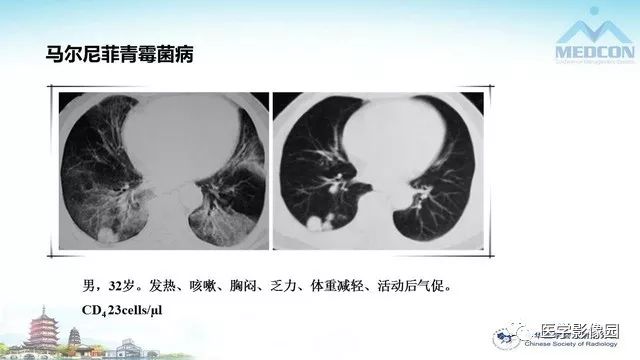 【PPT】AIDS并发播散性真菌病的CT表现