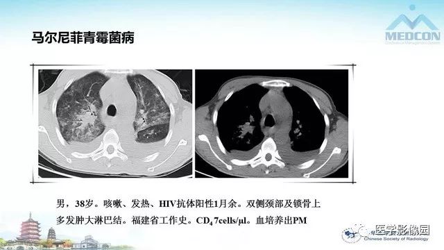 【PPT】AIDS并发播散性真菌病的CT表现