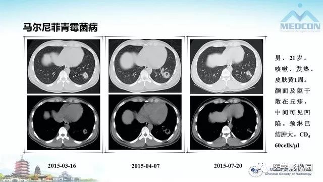 【PPT】AIDS并发播散性真菌病的CT表现