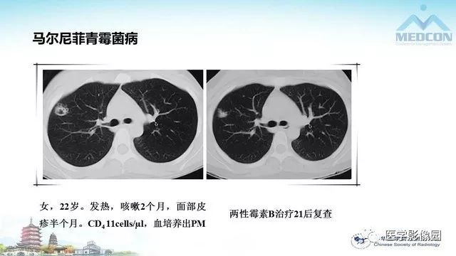 【PPT】AIDS并发播散性真菌病的CT表现